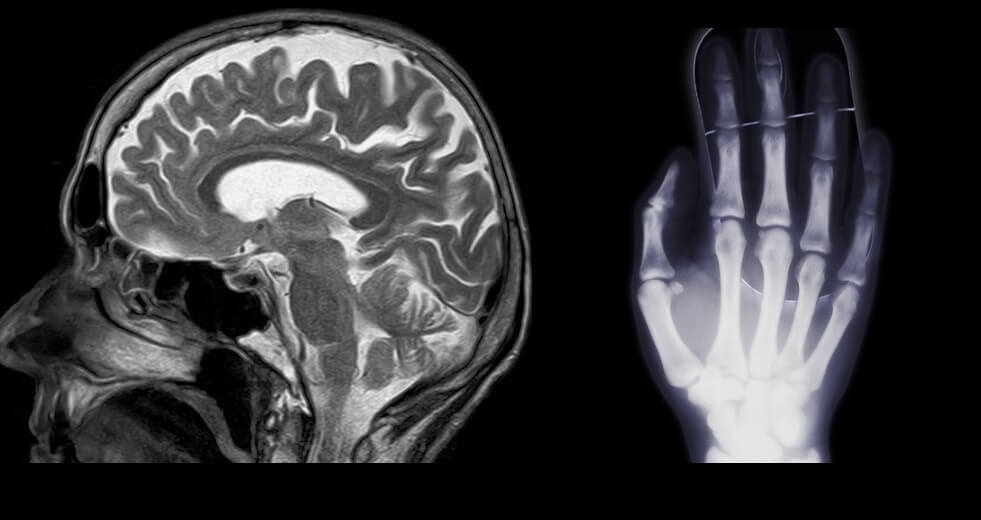 MRI-vs-xray