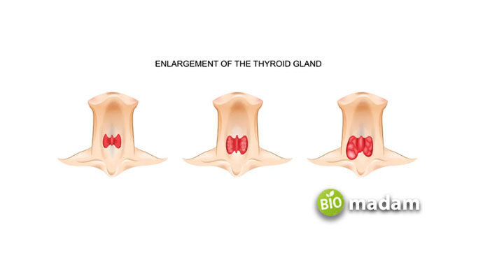 thyroid gland enlargement 