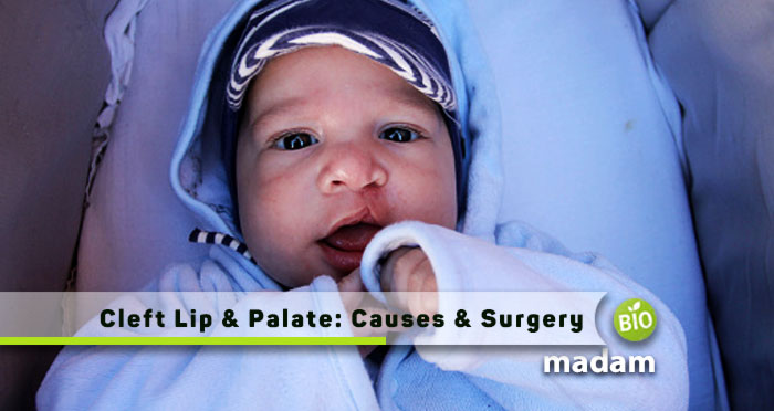 Cleft-Lip-&-Palate-Causes-&-Surgery
