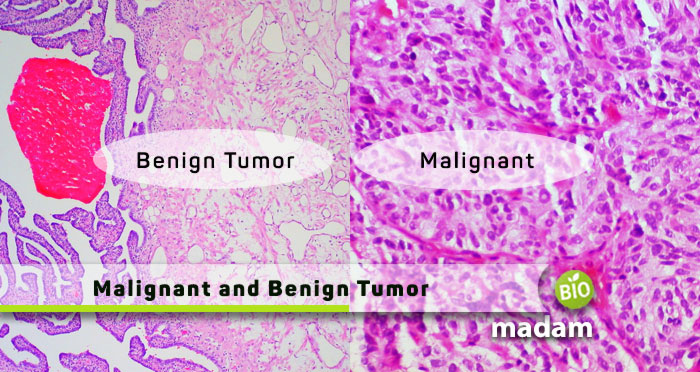 Malignant-and-Benign-Tumor
