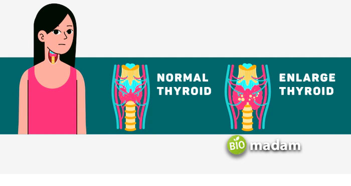 Normal-and-Enlarge-Thyroid