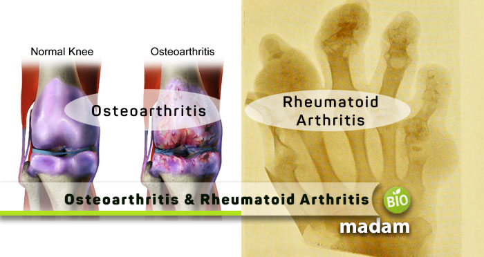 Osteoarthritis-and-Rheumatoid-Arthritis