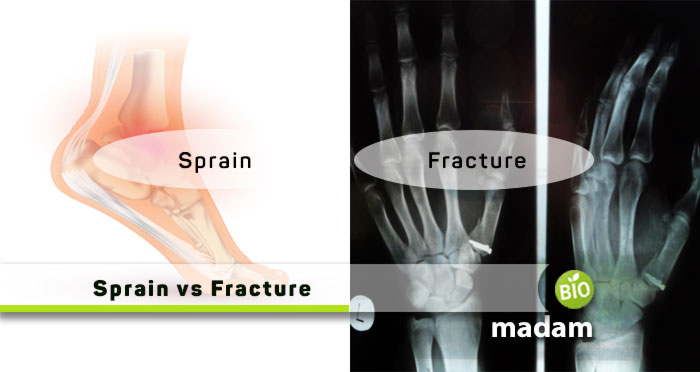 Sprain-and-Fracture