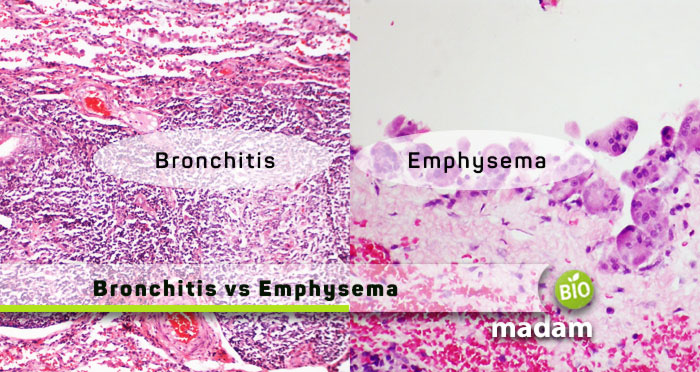 Bronchitis-vs-Emphysema
