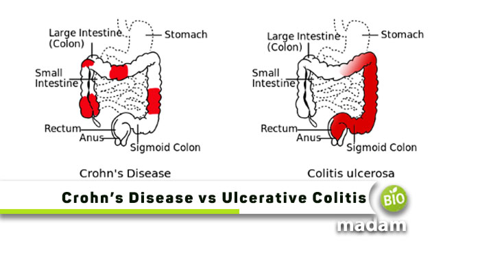 Crohn’s-Disease-vs-Ulcerative-Colitis
