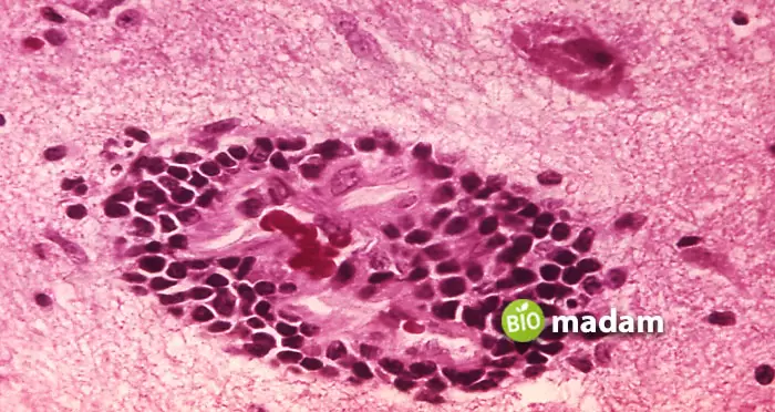 Encephalitis