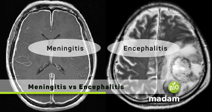 Meningitis-vs-Encephalitis
