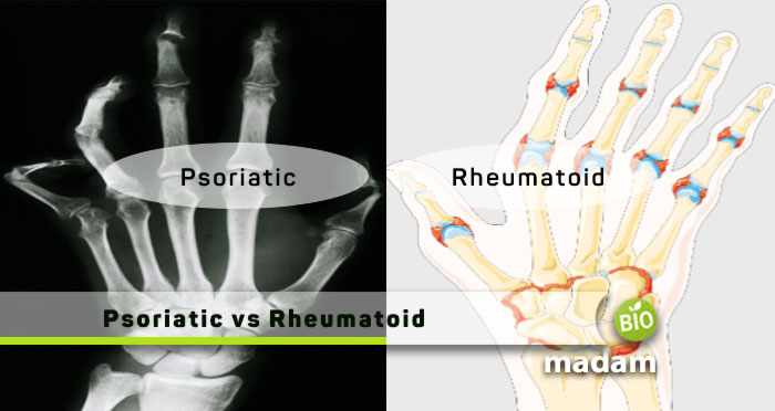Psoriatic-vs-Rheumatoid