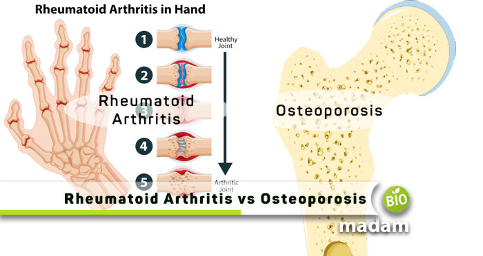 Rheumatoid-Arthritis-vs-Osteoporosis