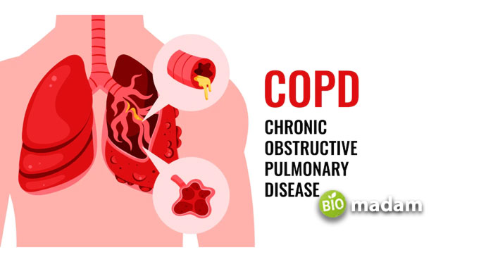 COPD