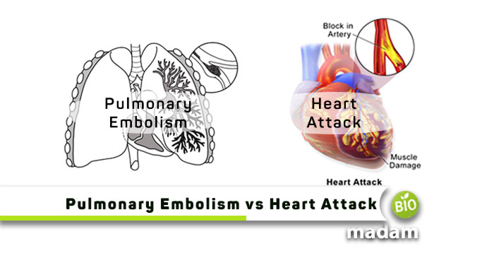 Pulmonary-Embolism-vs-Heart-Attack