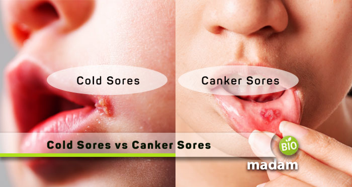 Cold-Sores-vs-Canker-Sores