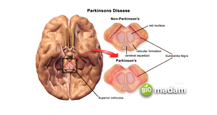 red-nucleus-in-Parkinson’s-disease