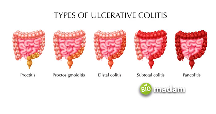 types-of-ulcerative-colitis