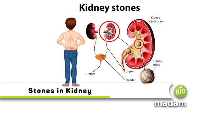 Stones-in-Kidney