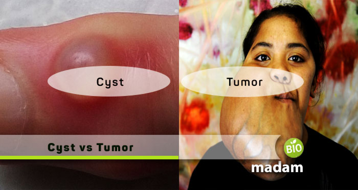 Cyst-vs-Tumor
