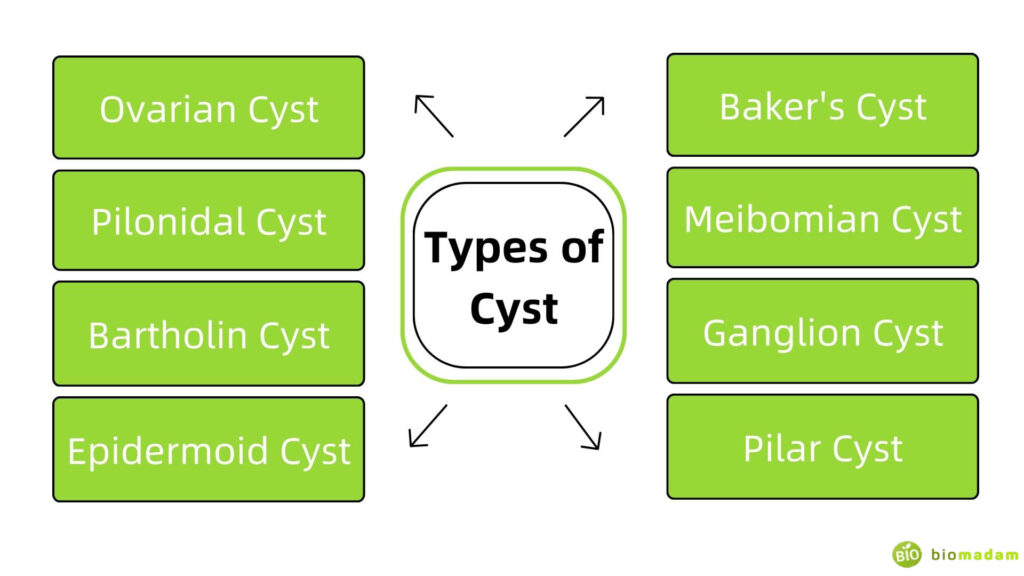 Types-of-Cyst
